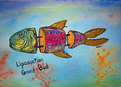 Liposuction